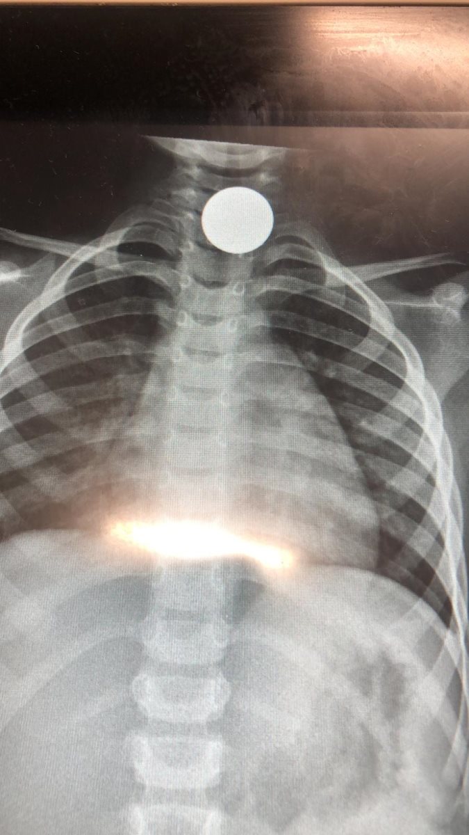 המטבע הזר בגרונו של עידן בן ה-5. קרדיט: דוברות בית החולים